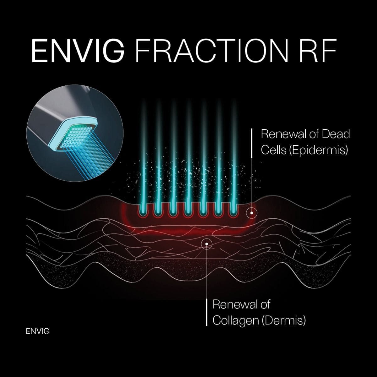 【官方授權代理】ENVIG EDGE by Tripollar 院線版 隔空無創微針射頻儀 提拉緊緻 收緊毛孔修復 香港行貨 2年保養