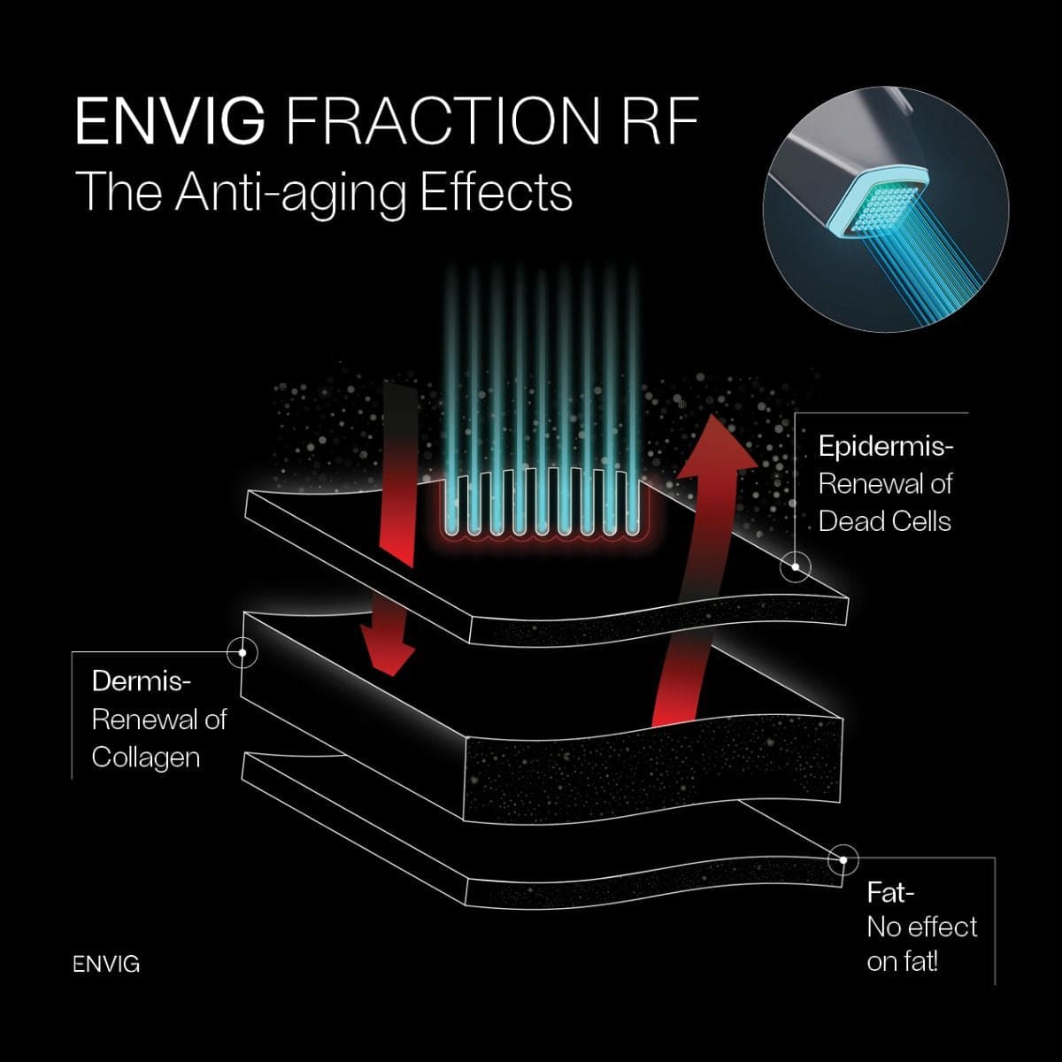 【官方授權代理】ENVIG EDGE by Tripollar 院線版 隔空無創微針射頻儀 提拉緊緻 收緊毛孔修復 香港行貨 2年保養