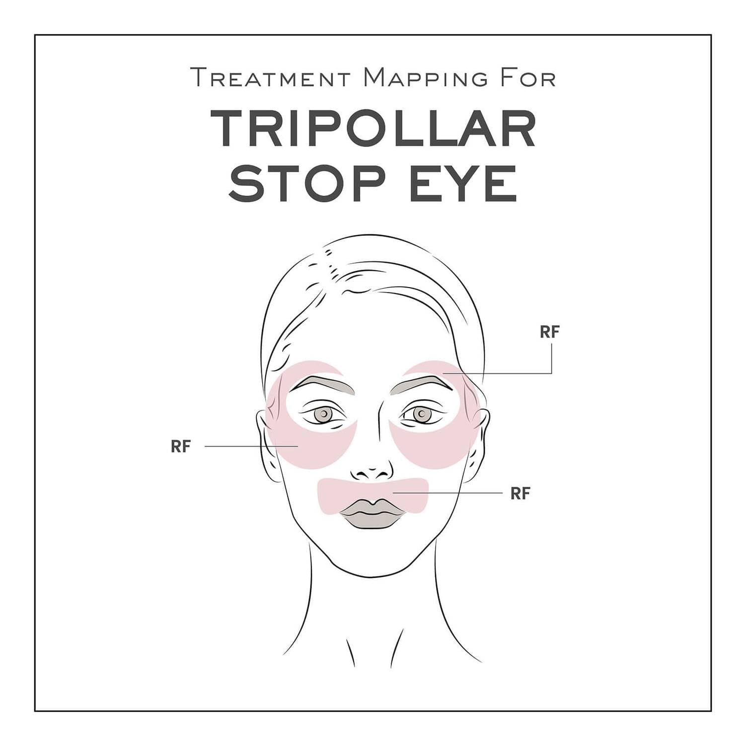 TRIPOLLAR STOP EYE 2+ 眼部射頻儀 淡紋緊緻 去眼袋黑眼圈 香港行貨