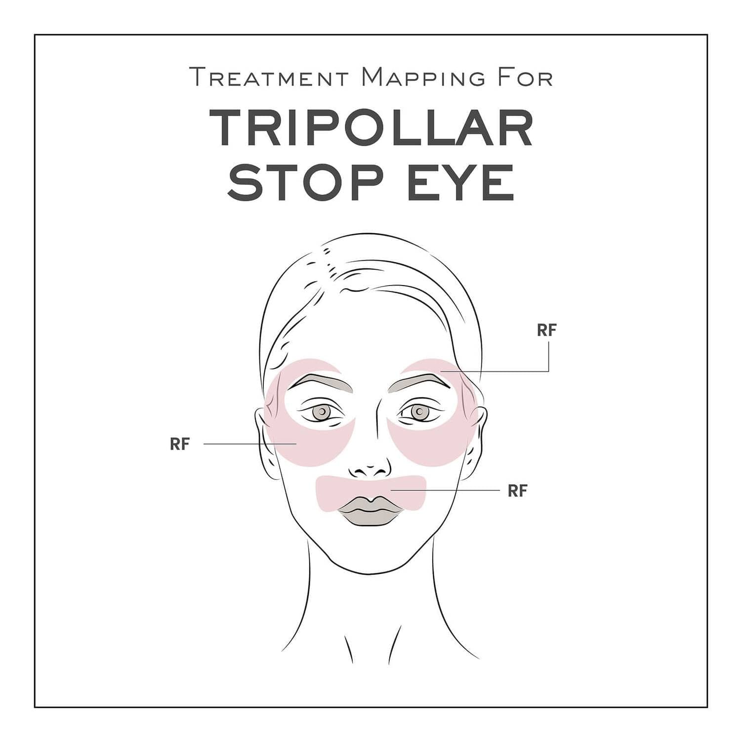 TRIPOLLAR STOP EYE 2+ MIRACLE YOUNG 眼部射頻儀 淡紋緊緻 去眼袋黑眼圈 香港行貨