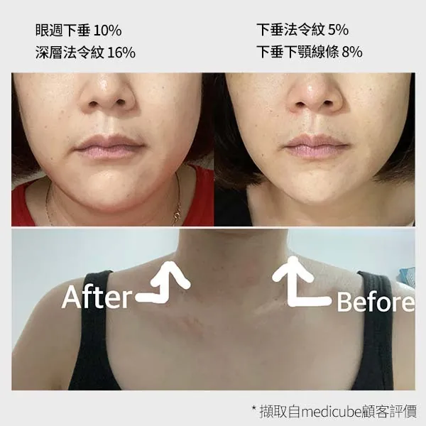 Medicube AGE-R EMS V面提拉
